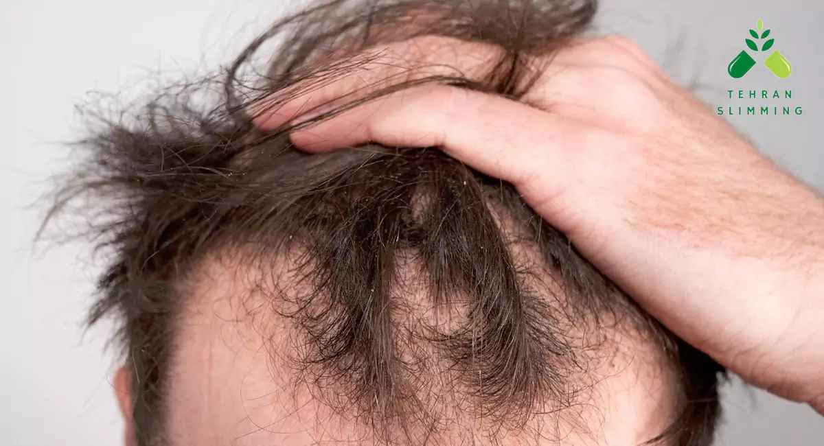 شامپو کندوش ضد ریزش با عصاره کندوش
